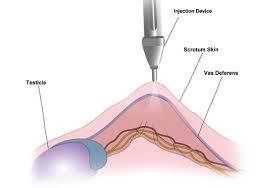 vasectomy, vasectomy near me,